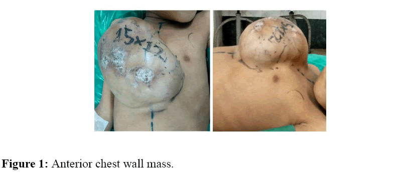 internalmedicine-Anterior-chest-wall-mass