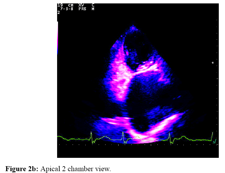 internalmedicine-Apical-2-chamber-view