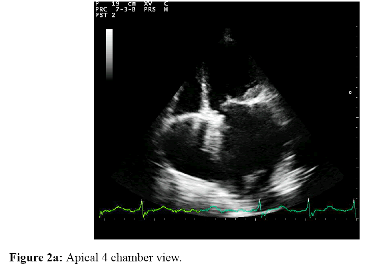 internalmedicine-Apical-4-chamber-view