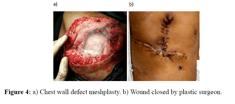 internalmedicine-Chest-wall-defect-meshplasty