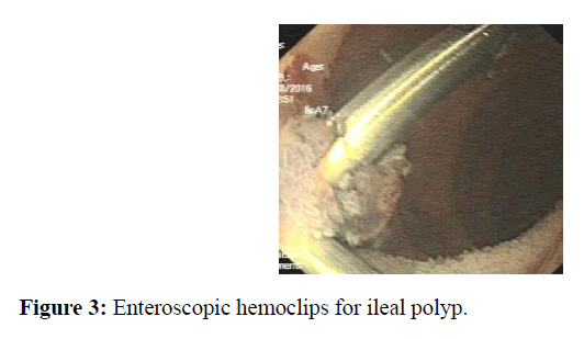 internalmedicine-Enteroscopic-hemoclips