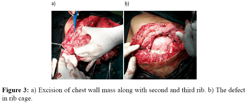 internalmedicine-Excision-chest-wall-mass-along-with-second-third