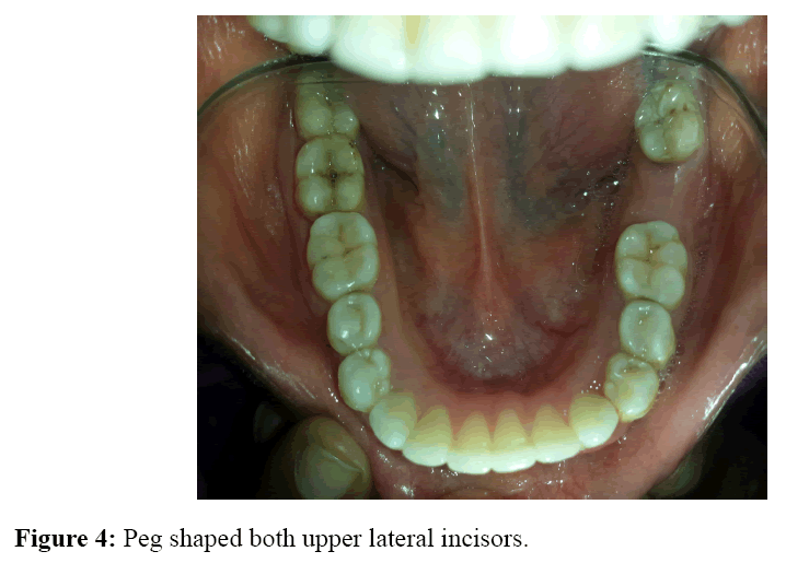 internalmedicine-Peg-shaped-upper-lateral-incisors