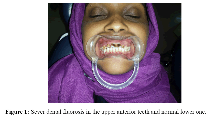 internalmedicine-Sever-dental-fluorosis