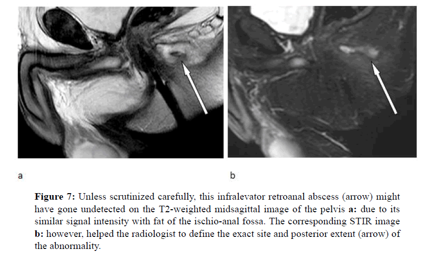 ischiorectal abscess mri