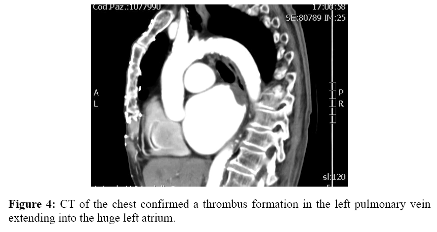 internalmedicine-thrombus-formation-left-pulmonary